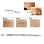 Stainless Steel Blackhead Extractor Tool